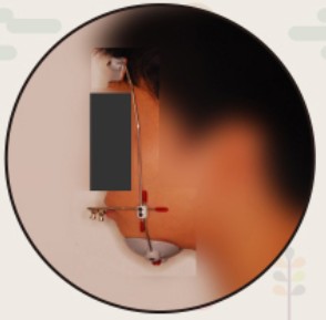 上顎前方牽引装置（装着時）